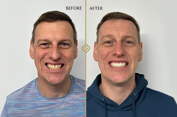 Invisalign