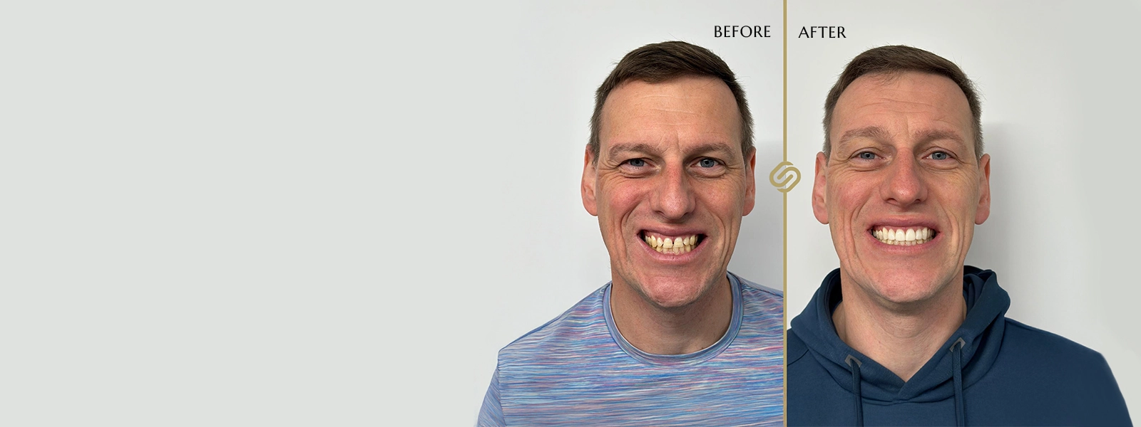 Invisalign