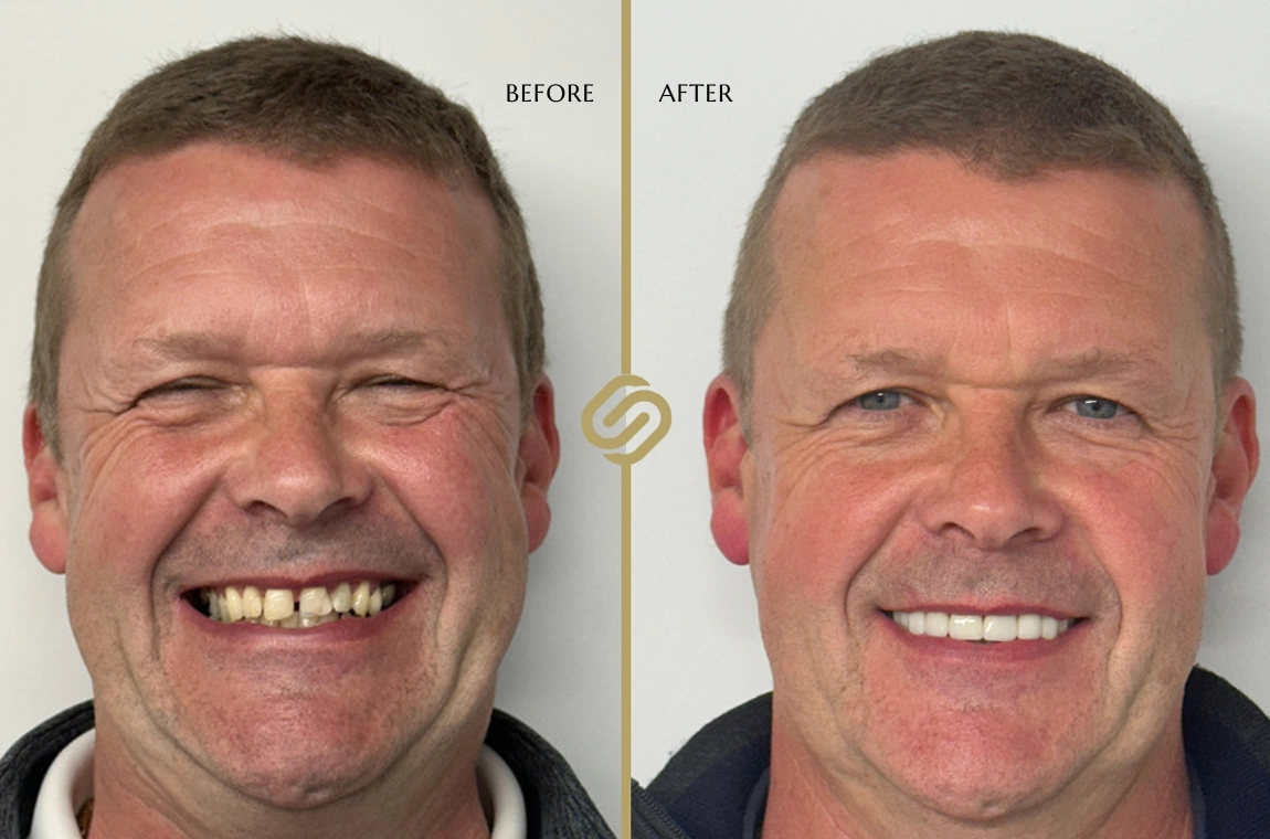 Invisalign