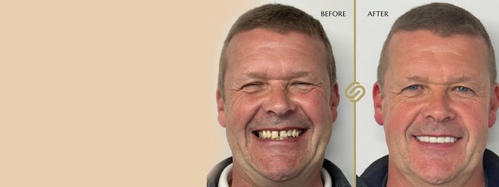 Invisalign